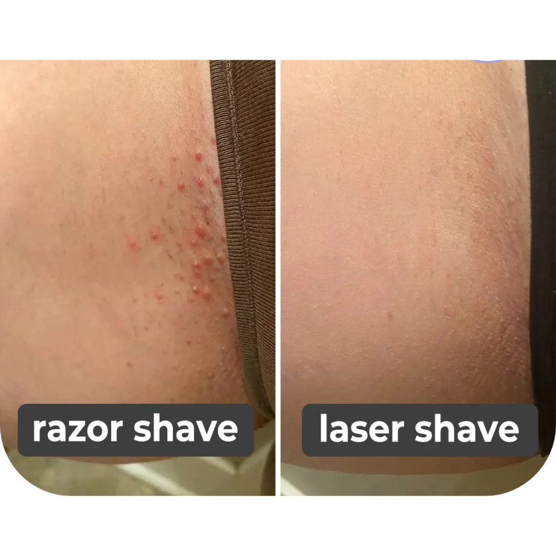 SmoothSkin™️ Hair Removal
